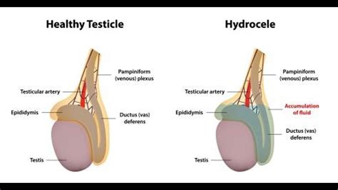 Epididymal Cyst Treatment Youtube