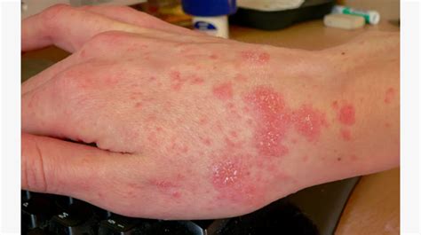 What Is Scabies Rashes Ms Health News