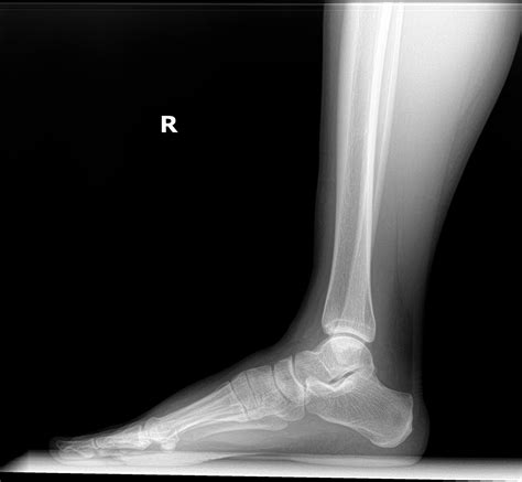 Orthodx Talus Osteonecrosis Clinical Advisor