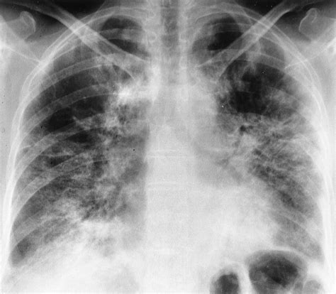 Pulmonary Drug Toxicity Radiologic And Pathologic Manifestations