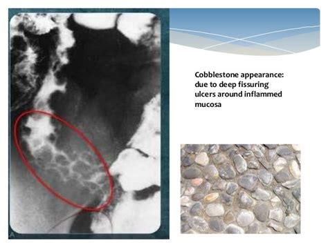 Inflammatory Bowel Disease Imaging Radiology