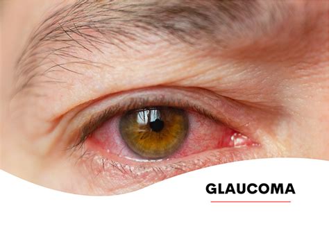 Glaucoma Saiba Tudo Sobre Glaucoma Sintomas Tratamentos Cirurgia