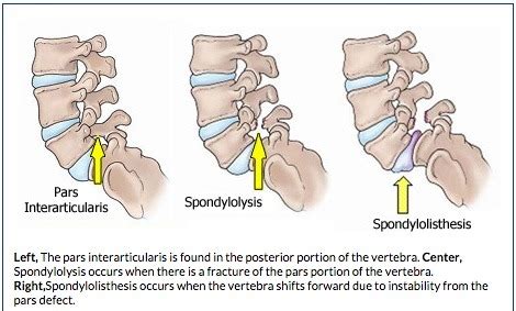 Musculoskeletal Ortho Emergencies Flashcards Quizlet