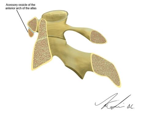 Accessory ossicle of the anterior arch of the atlas | Radiology Case ...