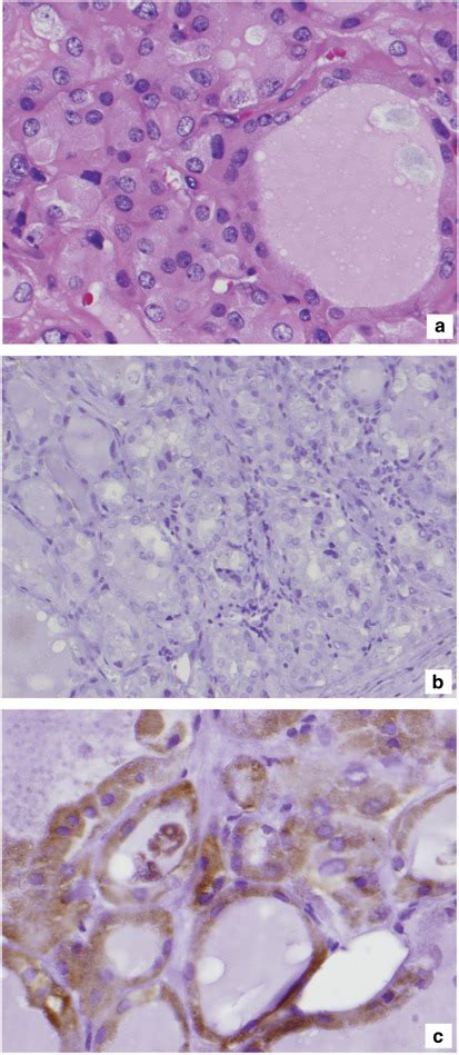 Immunohistochemical Markers In Diagnosis Of Papillary Thyroid Carcinoma