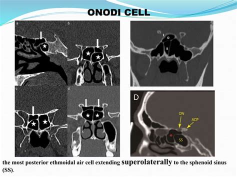 Sphenoid Sinus And Optic Nerve