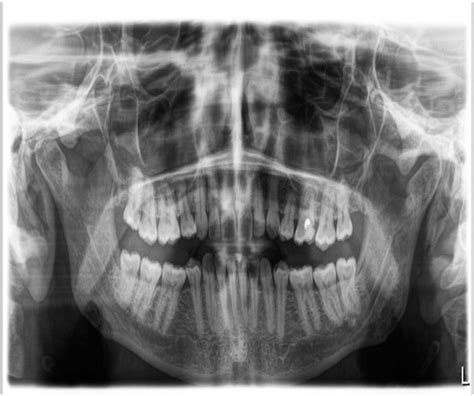 Case Series Use Of Coralline Hydroxyapatite Graft In Faciomaxillary