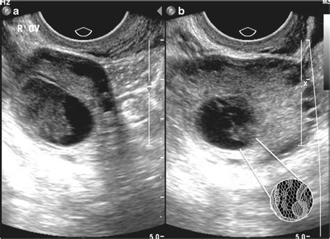 hemorrhagic ovarian cysts pacs