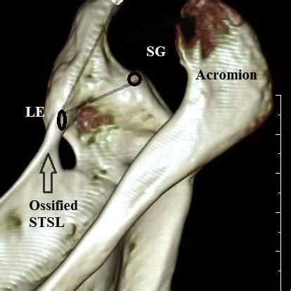 3D CT Reformatted Image Of Right Scapula From Dorsal View Showing