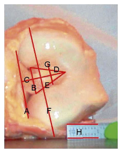 Intercondylar Notch Measurements Line “c” Is The Notch Height Line