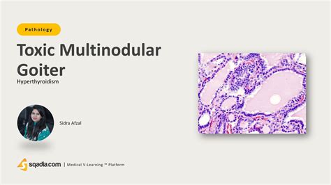 Hyperthyroidism Toxic Multinodular Goiter