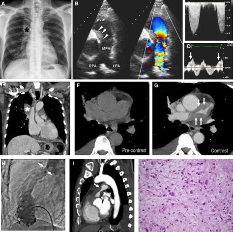 Pulmonary Artery Sarcoma Circulation Cardiovascular Imaging