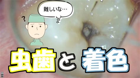 【リクエスト動画】虫歯と着色の見分け方 Youtube