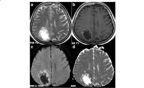 A Fse T2 Wi Axial Scan B Se T1 Wi After Intravenous Gadolinium Download Scientific Diagram