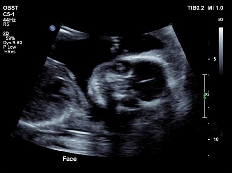 Congenital Cataracts Clinical Considerations In Ultrasound Diagnosis