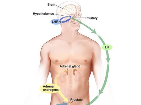 Androgen Deprivation Therapy For Recurrent Prostate Cancer National