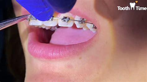 Brackets Repositioning Braces Check Up Heat Activated Wire Tooth