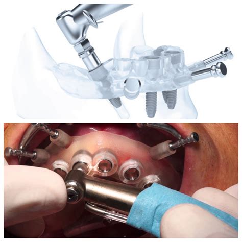 Cirugía guiada para implantes Dentales orthofacial es