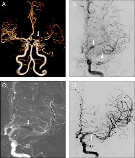 Endovascular Recanalization For Symptomatic Non Acute Middle Cerebral