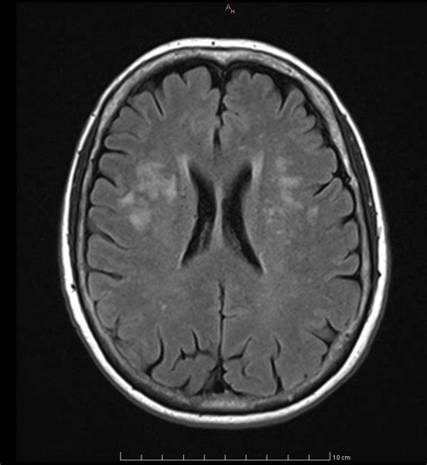 Periventricular White Matter Lesions Simple