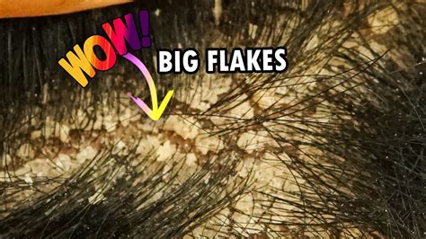 Big Flakes Dandruff Scratching Satisfying Dandruff Removal 238 Youtube