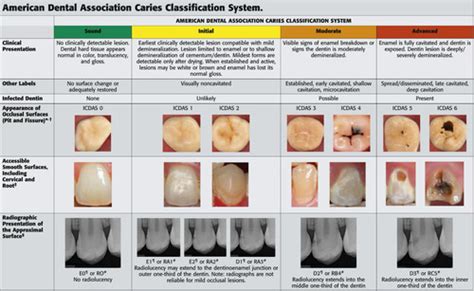 Session 19 Radiographic Interpretation Of Dental Caries Flashcards