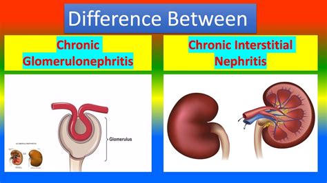 Glomerulonephritis