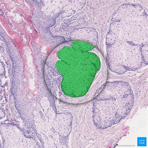 Sebaceous Cyst Diagram