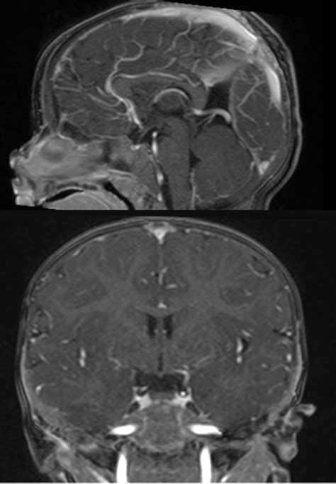 Figure Contrast Enhanced T1 Images Sagittal And Coronal Slices