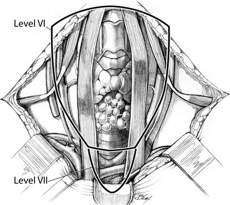 Central Compartment Lymph Node Dissection Operative Techniques In