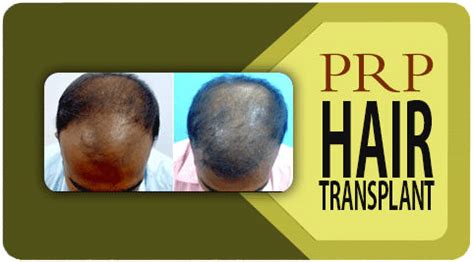 PRP Hair Treatment in India: Cost, Side Effects & Success Rate – Richardson's Plastic Surgery ...