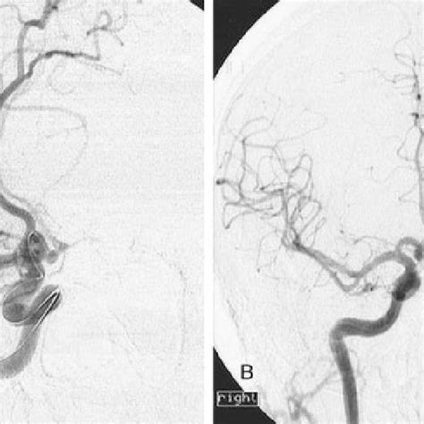 A Carotid Angiogram Right Side Frontal Projection Showing An Download Scientific Diagram