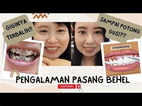 Jadi Gini Rasanya Pasang Behel Pengalaman Pakai Behel Tahun