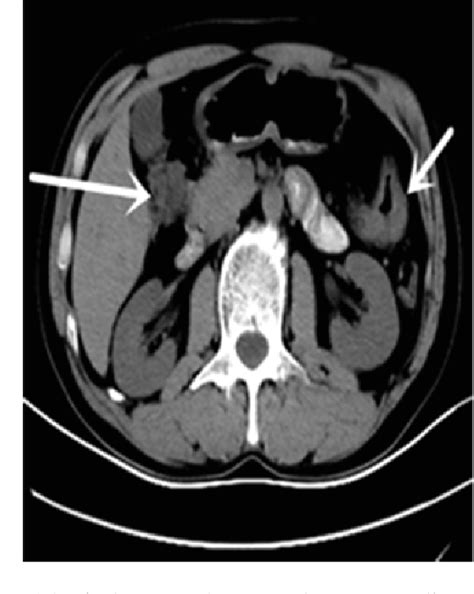 Figure 1 From Laparoscopic Subtotal Colectomy For Synchronous Triple