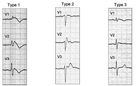 Brugada Syndrome Classification Wikidoc