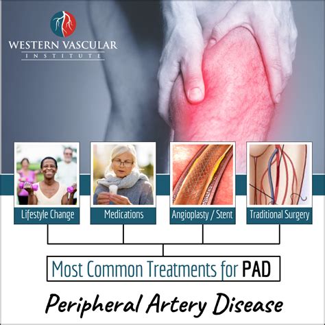 Common Peripheral Artery Disease Treatments Western Vascular Institute