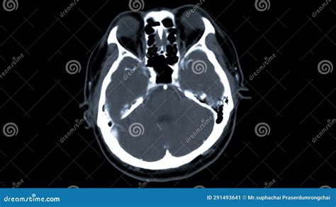 CT Scan of the Brain with Injection Contrast Media for Diagnosis Brain ...