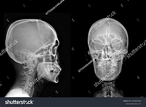X Ray Skull Anatomy