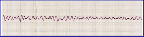 Electrocardiograma Qu Es La Fibrilaci N Ventricular