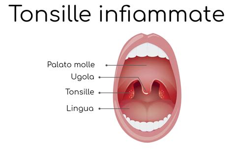 Operazione Alle Tonsille Tonsillectomia Tutto Quello Che Devi Sapere