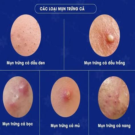 Mụn trứng cá là gì? Nguyên nhân và các cách phòng ngừa | Trị mụn, Mụn, Serum