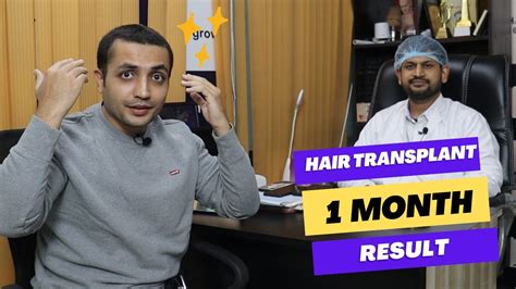 Hair Transplant Result After Month Shedding Phase After Hair