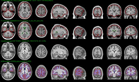 CORTICAL THICKNESS WORKFLOWS: CIVET AND FREESURFER, WITH A FOCUS ON ROI ...