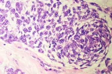 Intestinal Leiomyosarcoma: Background, Pathophysiology, Epidemiology