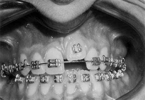 Treatment Of An Ankylosed Central Incisor By Single Tooth Dento Osseous Osteotomy American