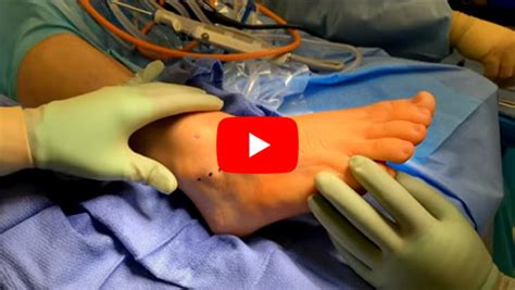 Ganglion Cyst Removal Toe