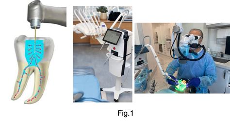 Enjoy Minimally Invasive Endodontics With Laser Activated Irrigation