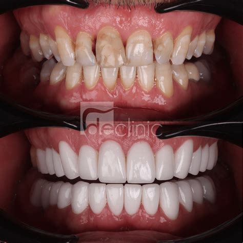 Couronnes Dentaires Dental Excellence Turkey Clinique Dentaire En