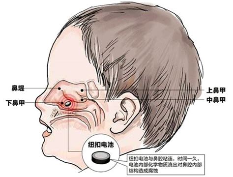 尚医科普全国爱鼻日调皮的鼻腔异物该如何处置