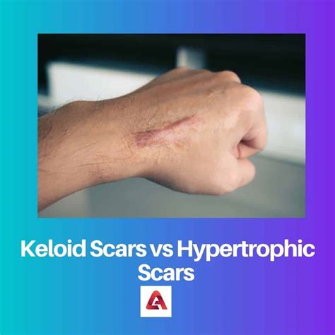 Keloid Vs Hypertrophic Scars Difference And Comparison